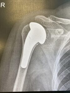 X-Ray of shoulder following Arthroplasty