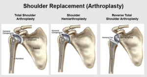 Diagram of the three types of shoulder arthroplasty