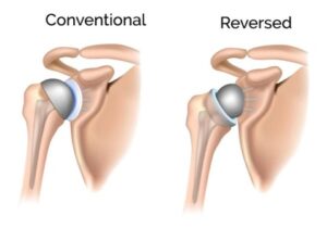 Visual display of conventional vs reversed shoulder arthroplasty