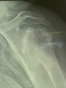 Osteoarthritic Shoulder Joint