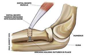 Graphic of surgery to the distal biceps tendon