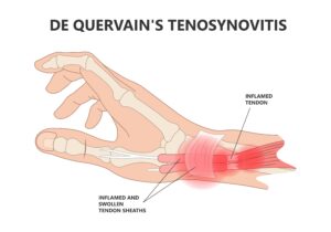 Anatomy of De Quervain's
