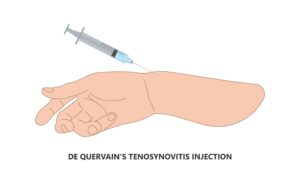 Diagram of cortisone injection