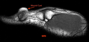 MRI of a mucoid cyst