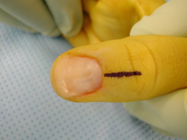 How To Address Nail Bed Injuries