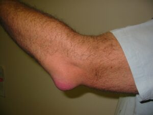Patient suffering from olecranon bursitis and the related swelling of the elbow