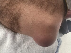 Image of swelling and tenderness created by olecranon bursitis