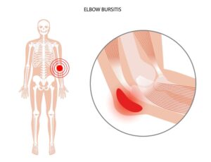 Visual display of the swelling olecranon bursitis can create within the body