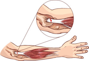 Visual depiction of the damage caused by tennis elbow