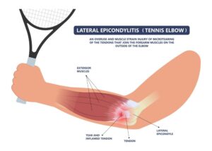 Diagram of the damage caused by Tennis Elbow