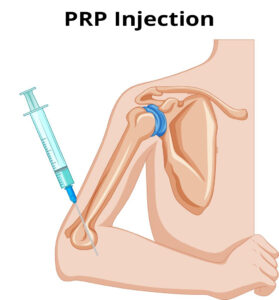 Diagram of PRP injection which assists in recovery