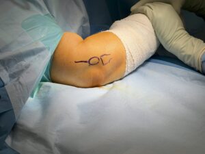 Preparation of Tennis Elbow Surgery