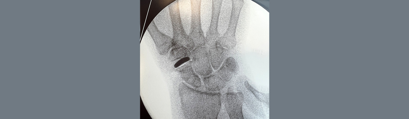 Arthritis of thumb