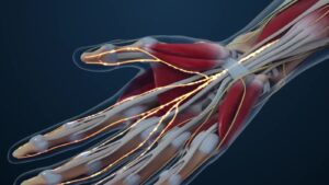 Treatment options for carpal tunnel syndrome