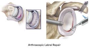 arthroscopic labral repair surgery