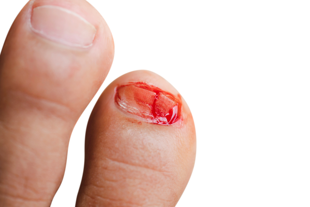 nail-bed-injuries-treatment-sydney-orthopaedic-surgeon