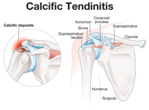 Diagram displaying the shoulder joint with calcific tendonitis