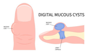 Visual depiction of a mucoid cyst