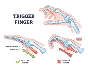 Anatomyof Trigger finger 