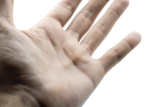Preventing Dupuytren’s Contracture: Strategies for Reducing Your Risk of Developing the Condition