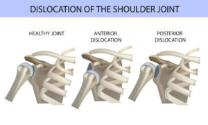 dislocation of the shoulder joint