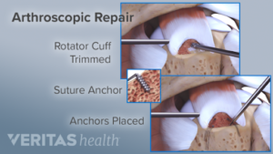 rotator cuff treatment