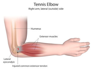 Anatomy related to Tennis Elbow
