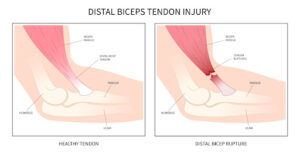 Diagram of the damage caused by a biceps tendon injury