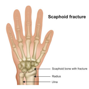 Scaphoid Fracture Anatomy