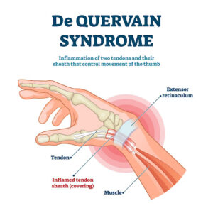 De Quervain's Syndrome Anatomy