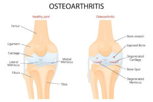 Osteoarthritis Anatomy