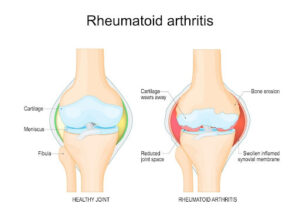 Rheumatoid Arthritis Anatomy