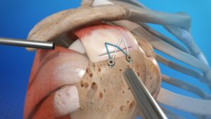 Arthroscopic repair of a torn shoulder tendon