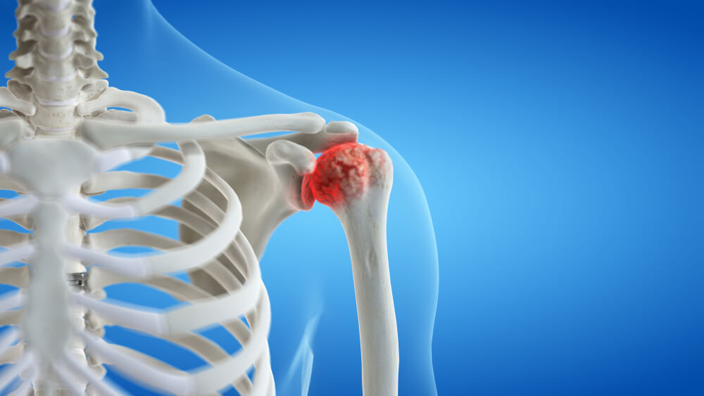 Managing Pain: Effective Relief Strategies For Shoulder Arthritis