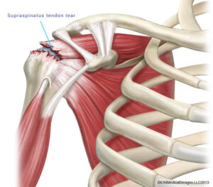 Torn shoulder tendon (supraspinatus tendon)