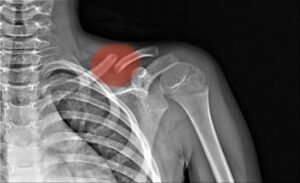 X-ray Of Shoulder